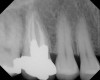 Figure 6  Root resorption secondary to orthodontic tooth movement.
