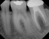 Figure 7  Clinical case of internal root resorption that was treated by orthograde root canal therapy.