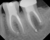 Figure 8  Clinical case of internal root resorption that was treated by orthograde root canal therapy.