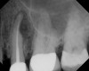 Figure 10  Clinical case of idiopathic resorption of the upper second bicuspid. The tooth was deemed hopeless and extracted.