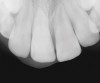 Figure 11  Clinical case of resorption related to the pressure of eruption (a progressive stress) on the upper right lateral incisor.