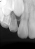 Figure 13  Clinical case of resorption related to the pressure of eruption (a progressive stress) on the upper right lateral incisor.