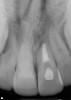 Figure 14  Clinical case of resorption related to the pressure of eruption (a progressive stress) on the upper right lateral incisor.
