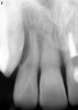 Figure 15  Clinical case of resorption related to the pressure of eruption (a progressive stress) on the upper right lateral incisor.