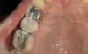 Figure 8  defective amalgam restoration with fractured cusp restored with packable RBC