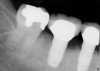 Figure 1  Periapical radiograph of a failed implant with peri-implantitis. Bleeding on probing and pus from the mesial pocket was present.