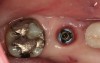 Figure 2  Following crown and abutment removal, the implant platform was exposed.