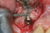 Figure 7   High-speed bur used to remove sufficient bone to reverse-torque the malpositioned implant.