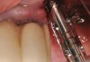 Figure 8  Trephine bur used to remove bone around the implant.