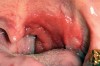 Figure 3  Erythroplakia of the left soft palate/tonsil complex.