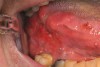 Figure 4  Erythroplakia biopsied and diagnosed as squamous cell carcinoma of the lingual tonsil area.)