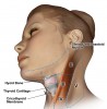 Figure 5  Cervical lymph node levels (I to VI).