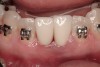 Figure 3  Pre-extraction situation. Tooth Nos. 24 and 25 were planned for extraction, and simultaneous ridge augmentation was planned. Implant placement in these two positions at the conclusion of active tooth movement was also planned.