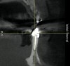 Figure 4  Cross-sectional views of tooth Nos. 24 and 25 failed to demonstrate the presence of labial and lingual bony cortices.