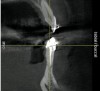 Figure 5  Cross-sectional views of tooth Nos. 24 and 25 failed to demonstrate the presence of labial and lingual bony cortices.
