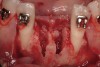 Figure 6  Following extractions, it was possible to visualize the facial and lingual bony walls.