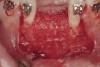 Figure 8  Resorbable mesh was shaped and affixed to the labial cortex with two PLGA resorbable fixation screws. The mesh was passively adapted over the edentulous crest and provided graft containment on the lingual aspect of the grafted defect.
