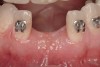 Figure 11  Six months after extraction and augmentation, orthodontic therapy was completed and the patient returned for implant placement. Adequate hard and soft tissues were present.