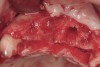 Figure 16  The edentulous anterior sextant. Portions of the facial bony wall remain in the maxillary left central and lateral incisor region. The long-standing abscess associated with tooth Nos. 7 and 8 has resulted in total loss of the bony plate in this area.