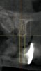 Figure 20  Scanning appliance worn by the patient for CT scan (Fig 19). Fabrication of a surgical template for flapless, computer-guided implant placement would be based on digital information obtained from the scan. Fig 20 demonstrates the cross-sectional view of the No. 8 position. Planning software demonstrated adequate 3-D volume for implant placement in this regenerated area where rhBMP-2/ACS and mesh were combined
