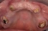 Figure 21  Five months after sinus and ridge augmentation healthy soft tissues were evident and the maxillary ridge was symmetric in the anterior sextant, where one side was originally deficient in ridge width.