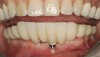 Figure 7  Absence of keratinized tissue often does not result in additional recession. Site No. 24 demonstrates recession at time of crown insertion (Fig 6). Fig 7 demonstrates that the tissue level has remained stable after 1 year. This patient had good oral hygiene.