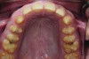 Figure 6. Preoperative maxillary occlusal view.