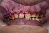 Figure 9. Marking gingival levels during crown lengthening.