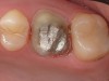 Figure 1  Completed crown preparation for maxillary molar.