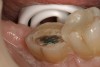 Figure 2  Facial view (Fig 2) and occlusal view (Fig 3) of nonretentive adhesively retained (