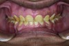 Figure 11. Gingival healing at 4 weeks.