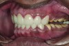 Figure 18. Posterior final tooth preparations: left side.