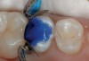 Figure 18  Phosphoric acid (30% to 40%) is ringed on the enamel first for 15 seconds and then run into the tooth for approximately another 10 seconds. It is then washed out, the tooth is briefly dried, and the restoration is finished using primers and adhesives.