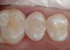 Figure 21  Phosphoric acid (30% to 40%) is ringed on the enamel first for 15 seconds and then run into the tooth for approximately another 10 seconds. It is then washed out, the tooth is briefly dried, and the restoration is finished using primers and adhesives.