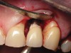 Figure 5  Excess cement noted below the crown margin resulting in peri-implant inflammation as shown in Figure 3. After facial and palatal flap elevation for direct visualization, excess cement was removed with curettes. Care was taken to avoid scratching the abutment surface. The site was irrigated with a 0.12% chlorhexadine-based oral rinse; flaps were replaced and closed with resorbable gut suture.