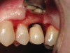 Figure 13  Clinical photograph demonstrating excess cement below the crown margin with resulting circumferential bone loss.