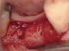 Figure 3  Re-entry demonstrating complete bone fill.