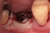 Figure 4  Transmucosal healing of implant No. 30.