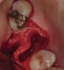 Figure 6  Extraction socket of tooth No. 3 demonstrating loss of distobuccal cortex.