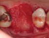 Figure 7  Obturation of extraction socket with rhBMP-2/ACS.