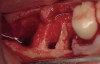 Figure 10  Extraction and debridement of tooth Nos. 30 through 32.