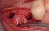 Figure 11  Osteotomy preparation for two 4.8-mm wide implants into regenerated native bone.