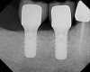 Figure 13  Radiograph at time of restoration of two separate implants, with cement-retained crowns and healthy proximal bone levels.